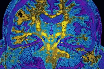 The brain is seen in a colorful scan.