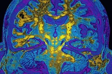 The brain is seen in a colorful scan.