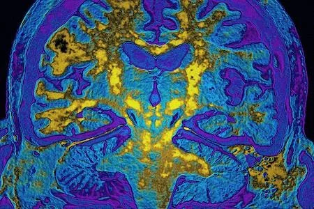 The brain is seen in a colorful scan.