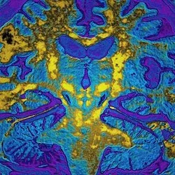 The brain is seen in a colorful scan.